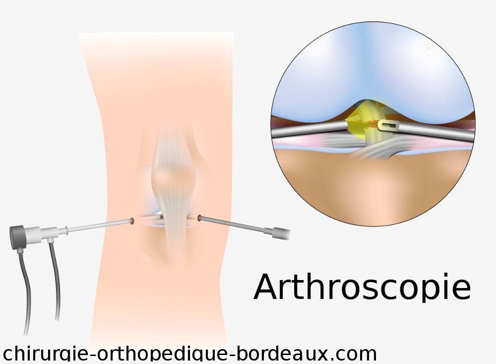 Arthroscopie du genou, traitement du Ménisque