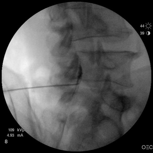 Infiltration foraminale sous radioscopie