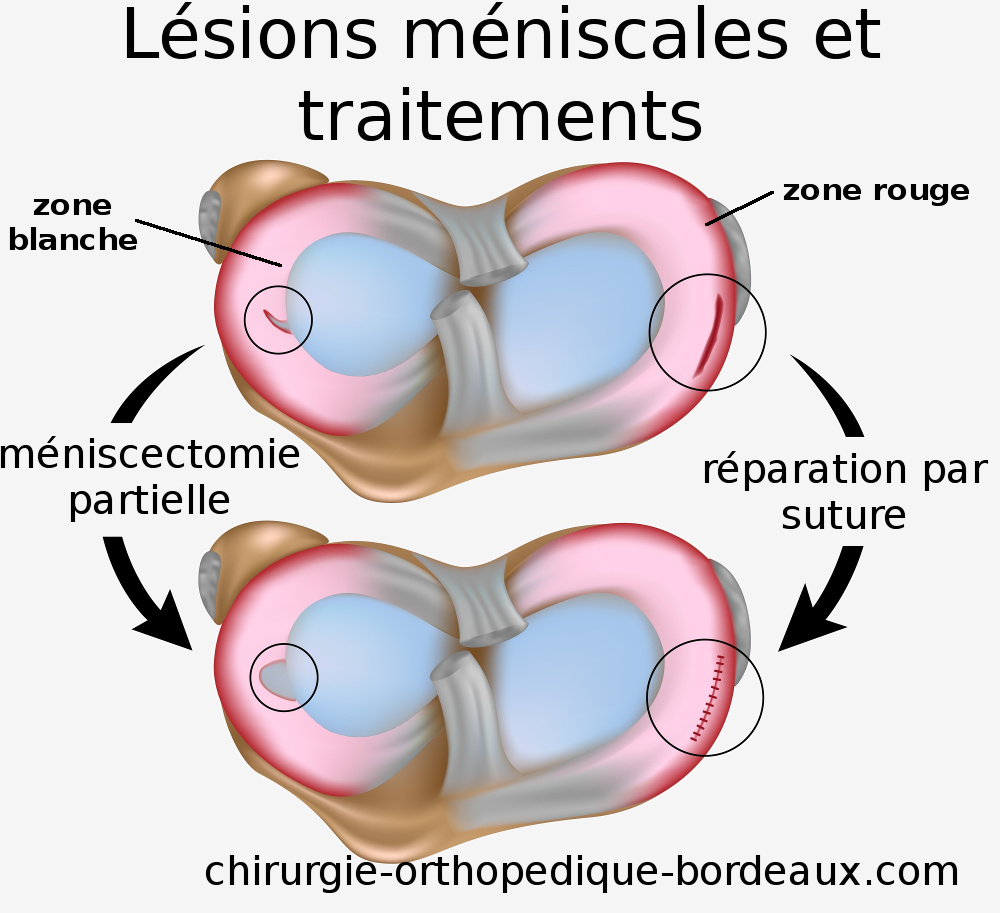 lésion et déchirure du Ménisque réparation suture