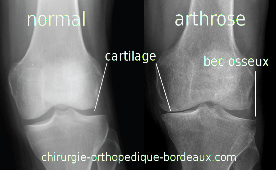 Radiographie radio genou arthrose gonarthrose