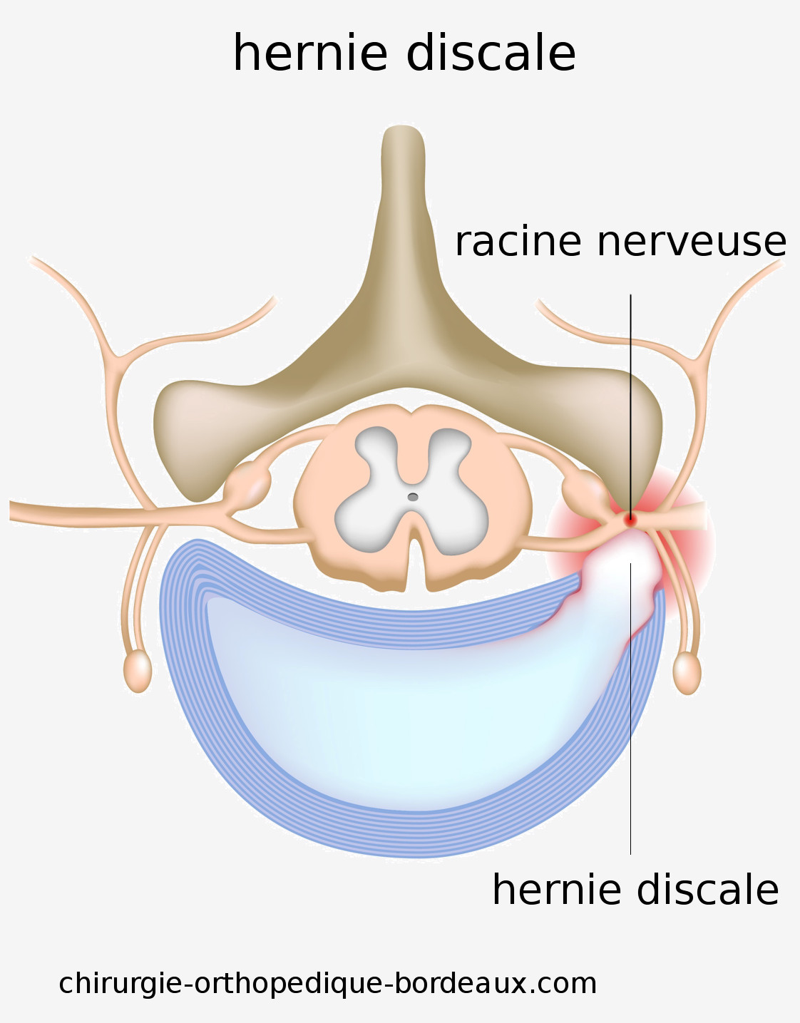 Schema d'une hernie discale provoquant une douleur sciatique