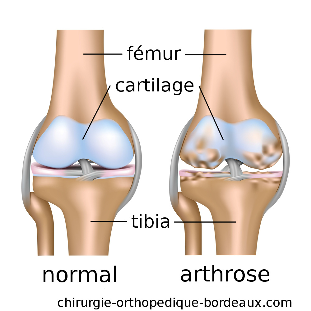 Schéma Gonarthrose arthrose genou