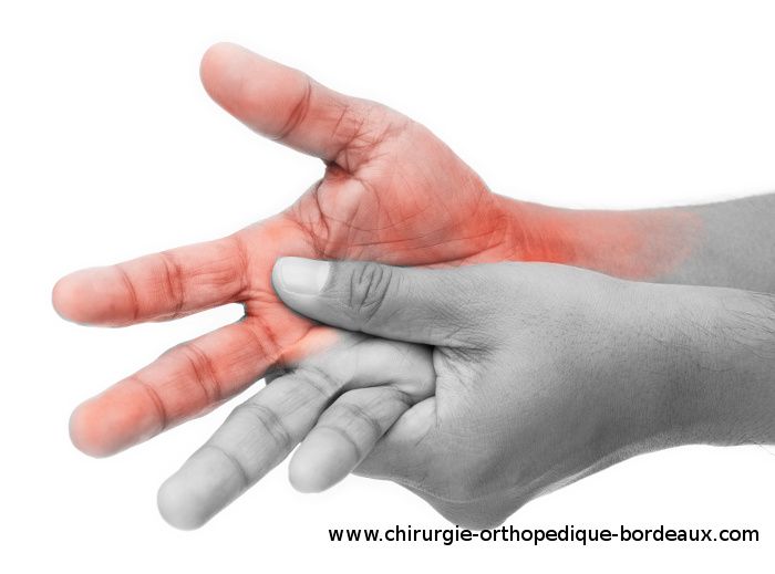 main avec douleurs de syndrome du canal carpien
